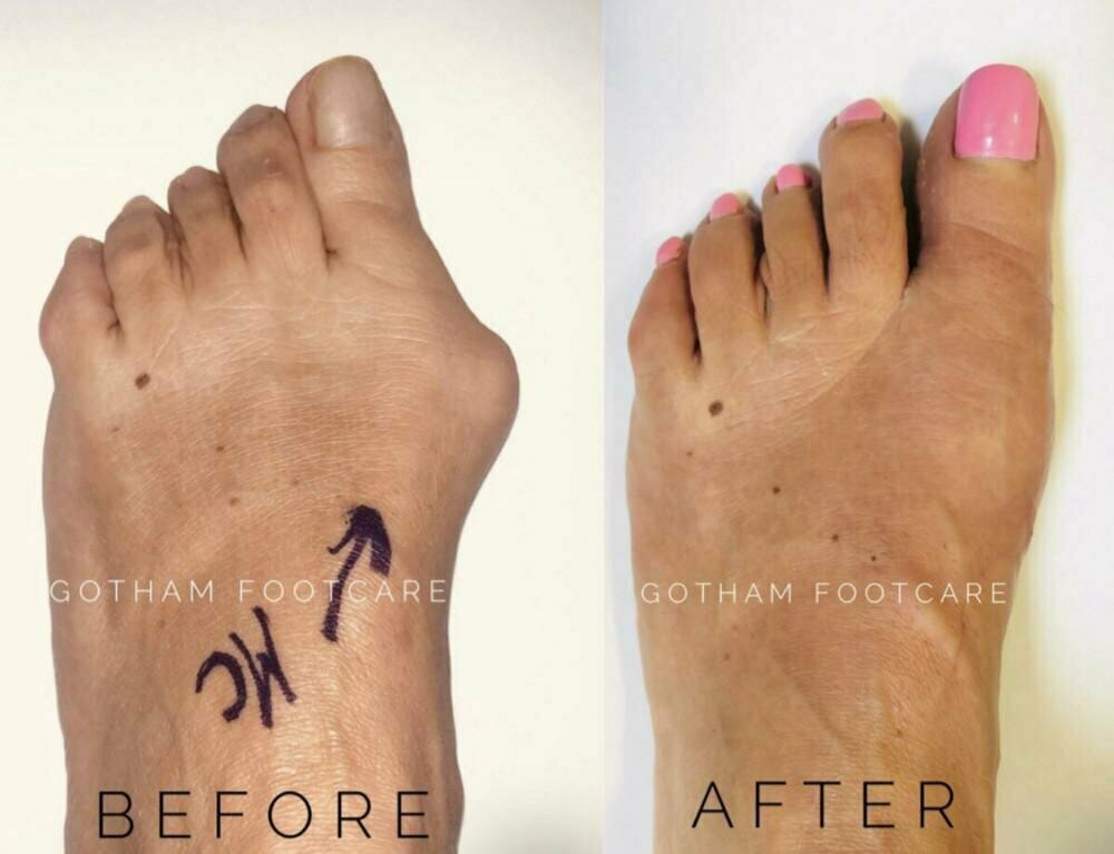 Why You Shouldn't Ignore That Bunion Pain? | Blog | Gotham Footcare