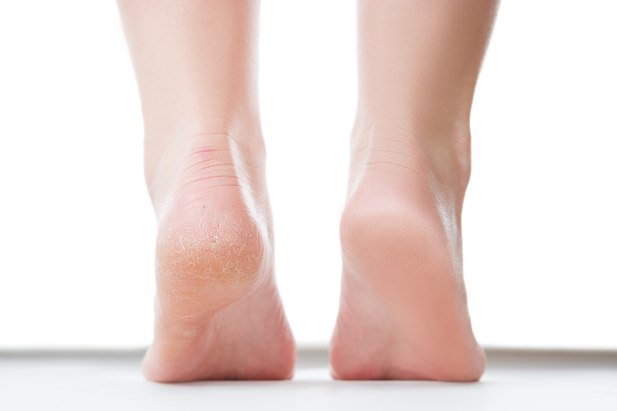 What Really Causes Cracked Heels (Part 1) | Blog | Gotham Footcare