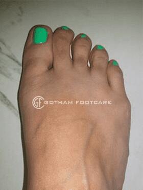 Bunion Surgery Before & After Image