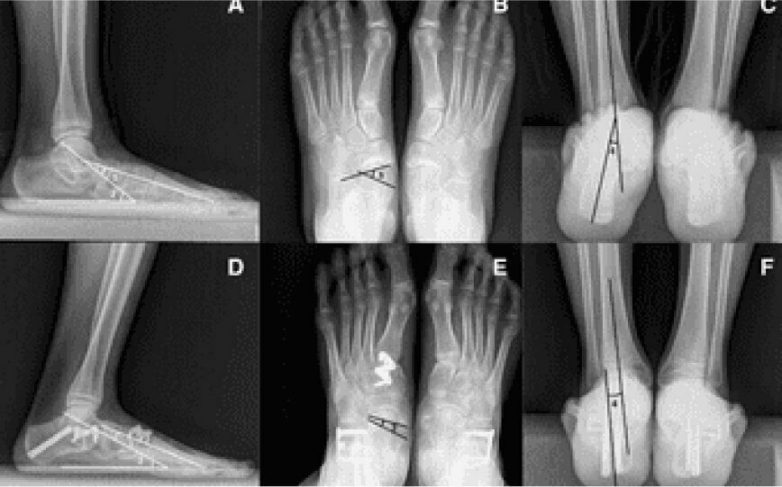 What You Need To Know About: Flat Foot Reconstruction Surgery
