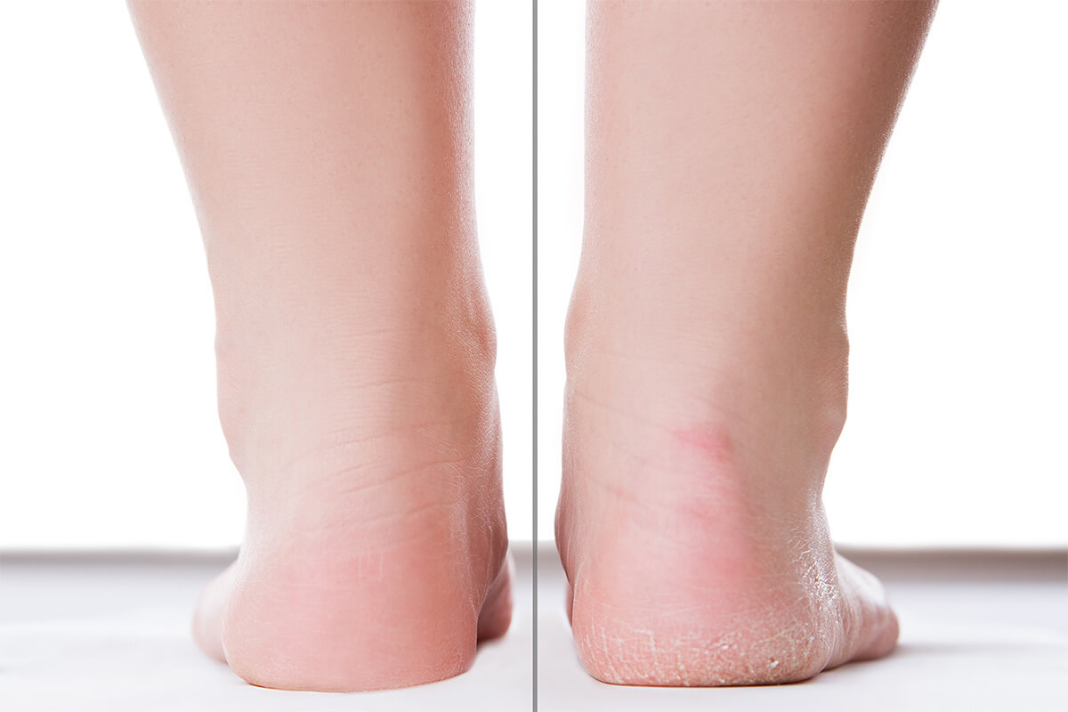 An Expert’s Guide to Healing Cracked Heels | Blog | Gotham Footcare