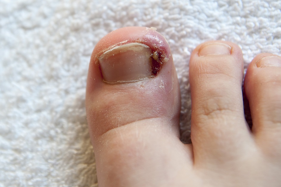 Do I Need to Visit a Foot Doctor for My Ingrown Toenail?