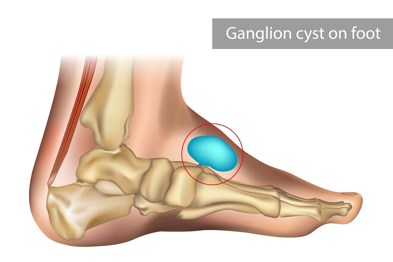 Understanding Ganglion Cysts: What They Are and How They Are Treated