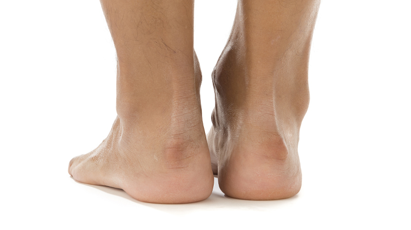 FAQs: Haglund’s Deformity | Gotham Footcare