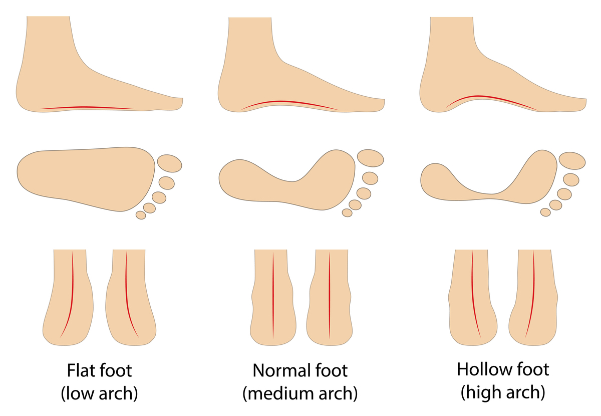 Know your Arch type: Low Arch Feet or Flat feet, Normal feet and Hollow feet or High Arch feet