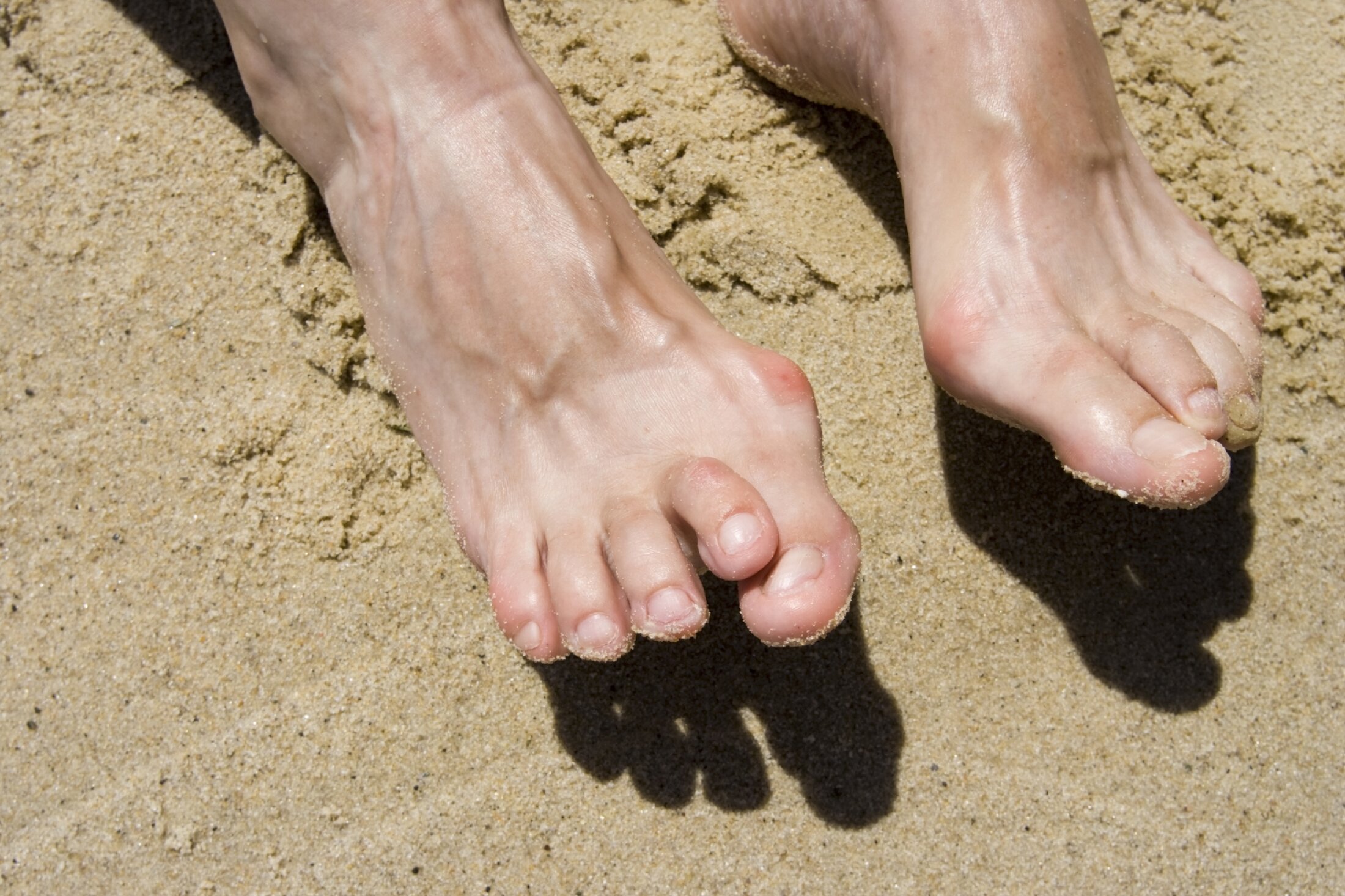 Straightening the Path to Comfort- Medical Solutions for Crooked Toes