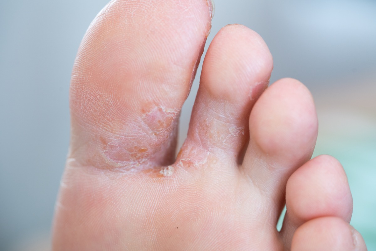 Top 5 foot conditions seen by podiatrists | Blog | Gotham Footcare