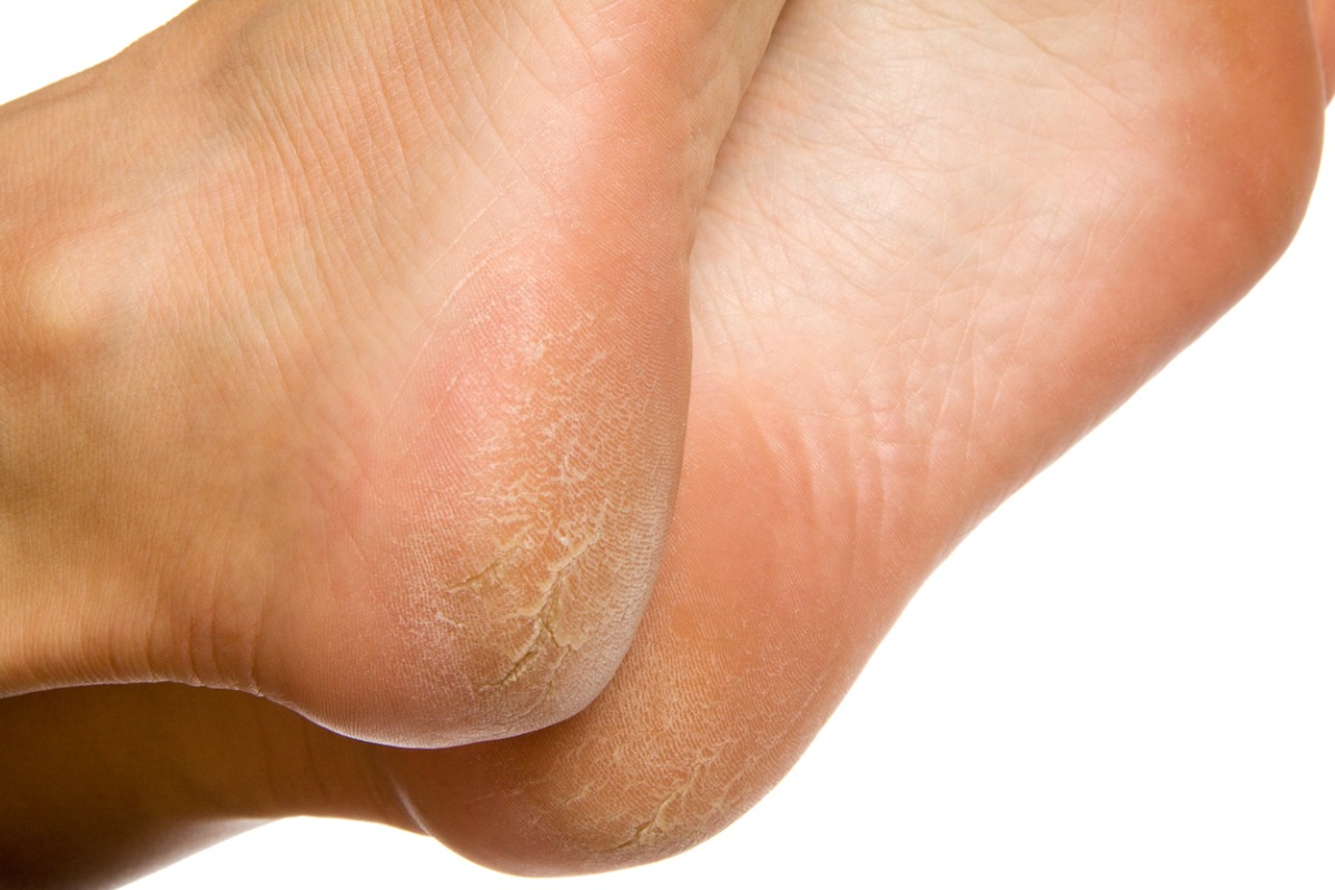 Heel Callus Cracked heels - Podantics Podiatry Adelaide