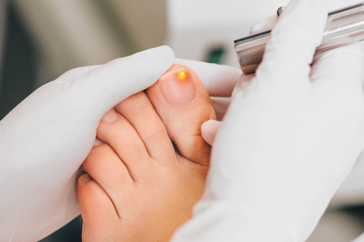 Laser Treatment for Toenail Fungus