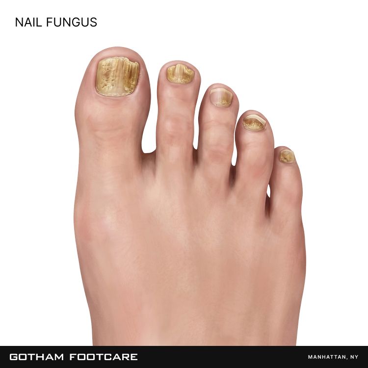Nail Fungus | Podiatry Condition