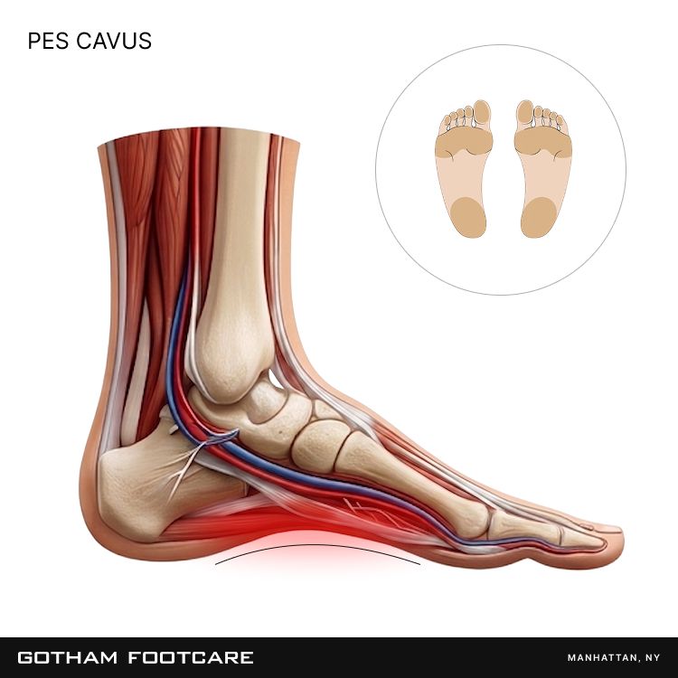High-Arched Feet | Podiatry Condition | Gotham Footcare