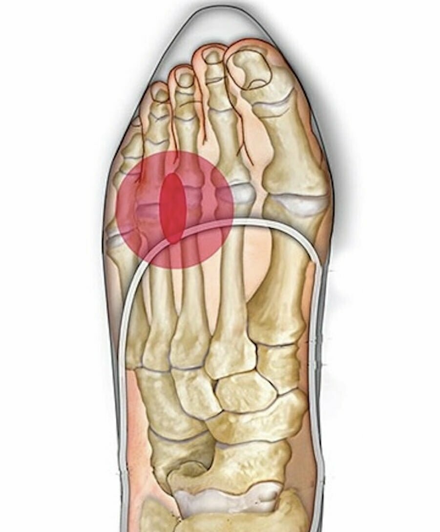Morton's Neuroma Treatment New York