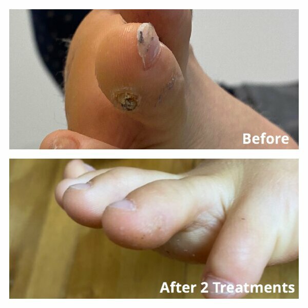 NYC before and after of wart
