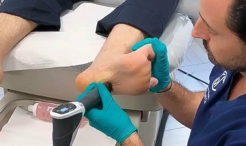 Shockwave Therapy applied to foot