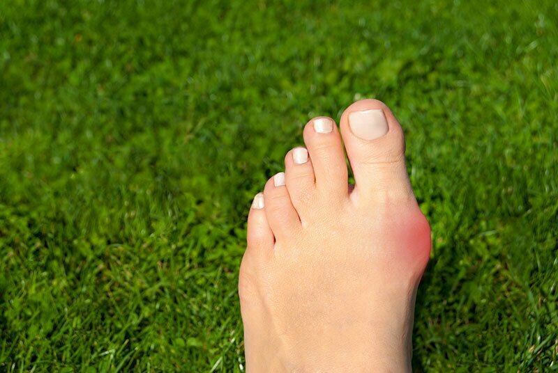 bunion on foot