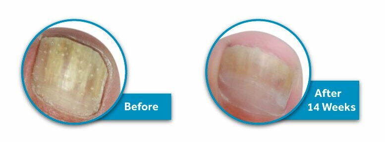before and after of toenail fungus treatment