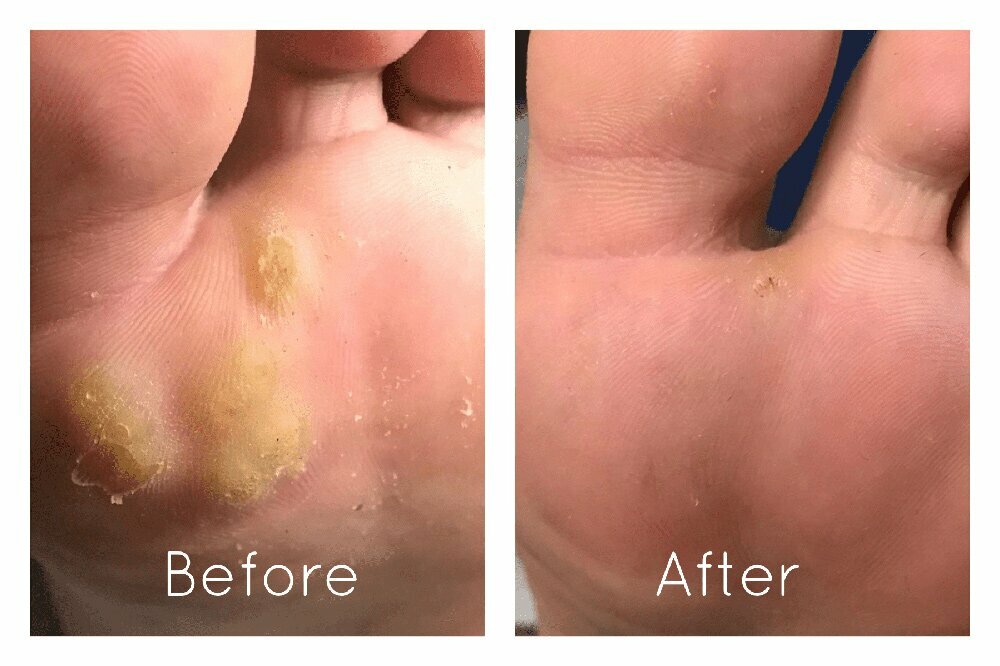 Before & After Plantar Wart Treatment NYC