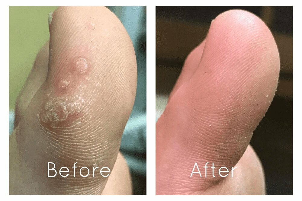 Before & After Plantar Wart Treatment NYC
