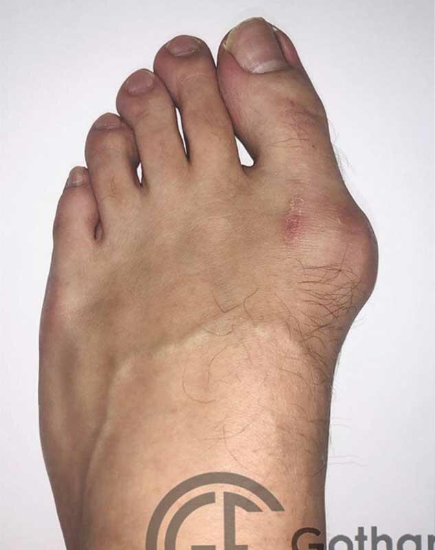 Bunion Surgery Before & After Image
