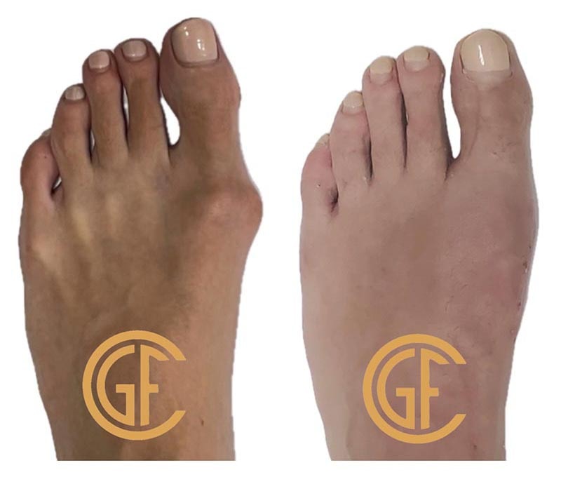 Minimally Invasive Bunion Surgery Before & After Image