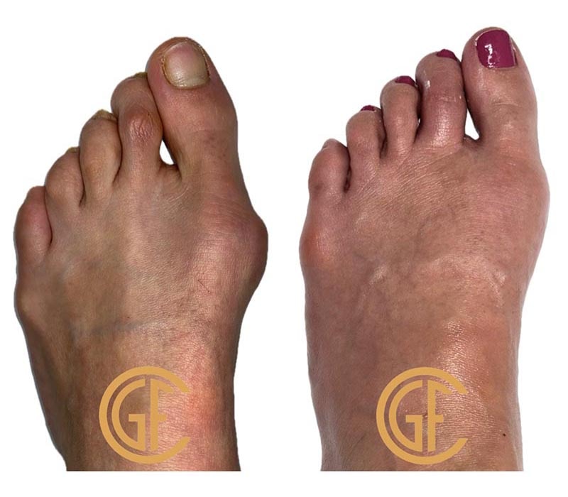 Minimally Invasive Bunion Surgery Before & After Image