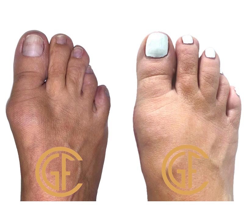 Minimally Invasive Bunion Surgery Before & After Image