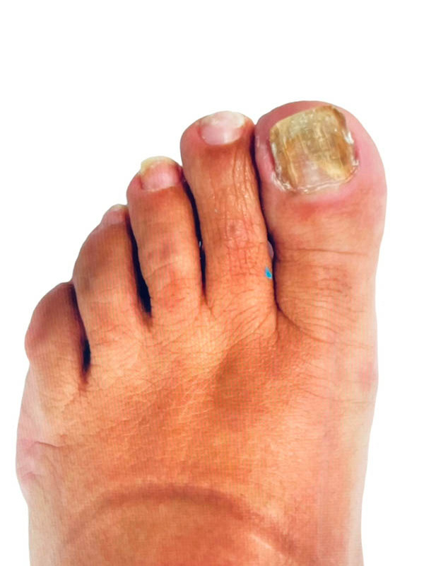 Nail Fungus Before & After Image