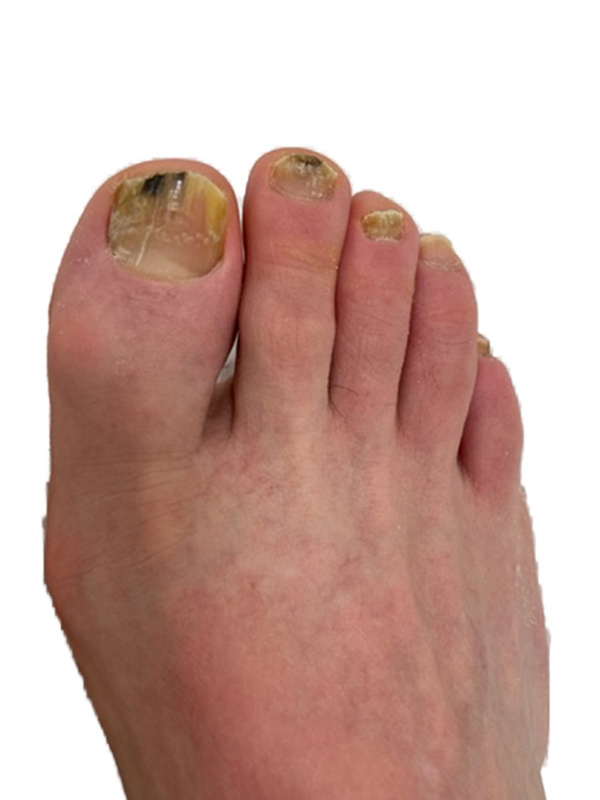 Nail Fungus Before & After Image