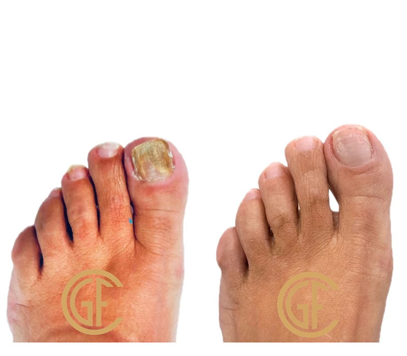 Nail Fungus Before & After Image