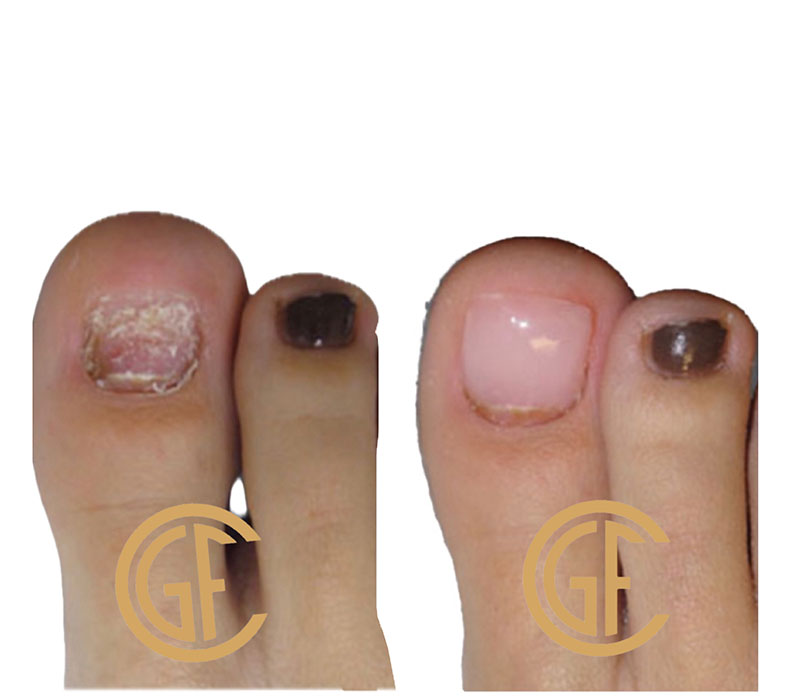 Nail Restoration Before & After Image