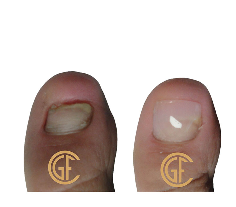Nail Restoration Before & After Image