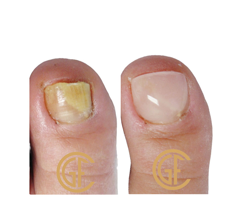 Nail Restoration Before & After Image