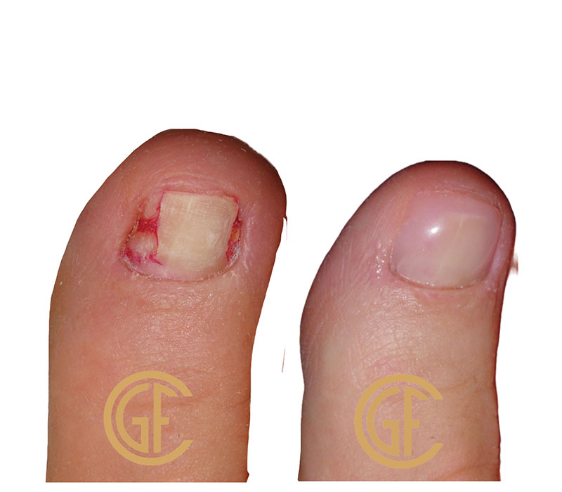 Nail Restoration Before & After Image