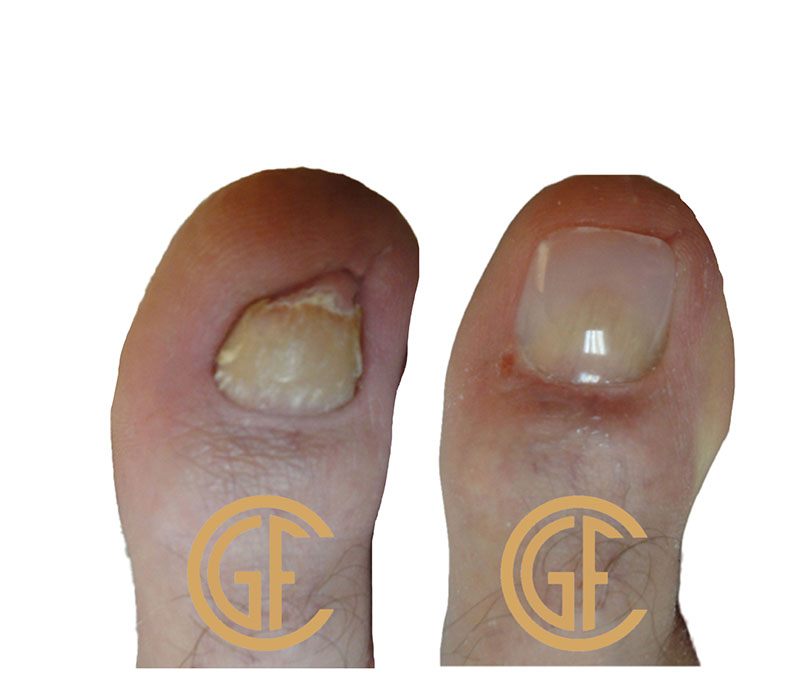 Nail Restoration Before & After Image