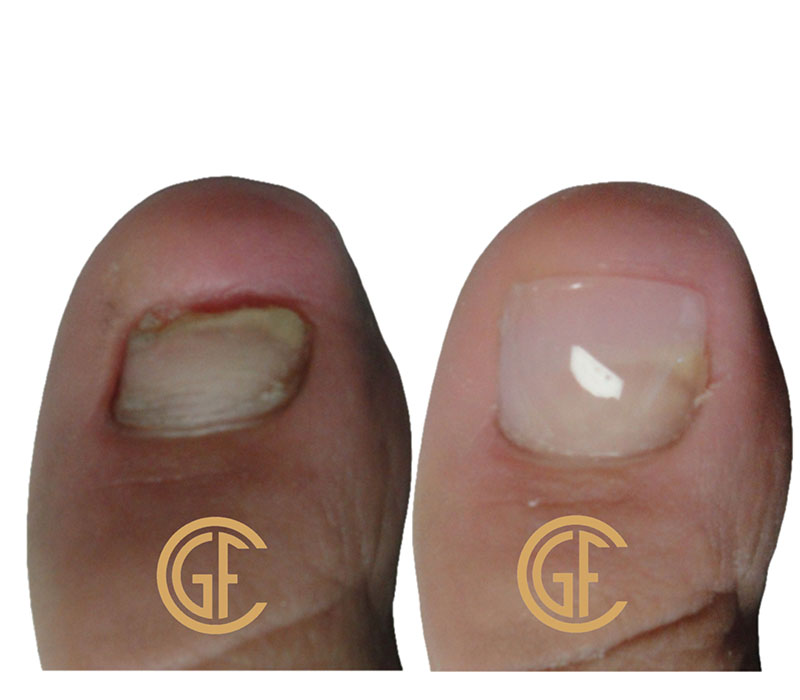 Nail Restoration Before & After Image