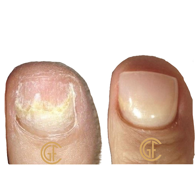 Nail Restoration Before & After Image
