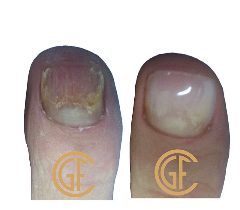 Nail Restoration Before & After Image