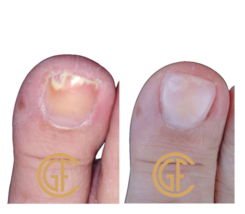 Nail Restoration Before & After Image