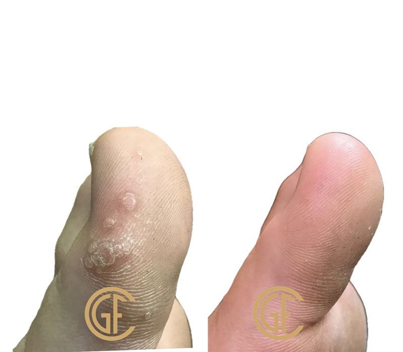 Plantar Warts Before & After Image