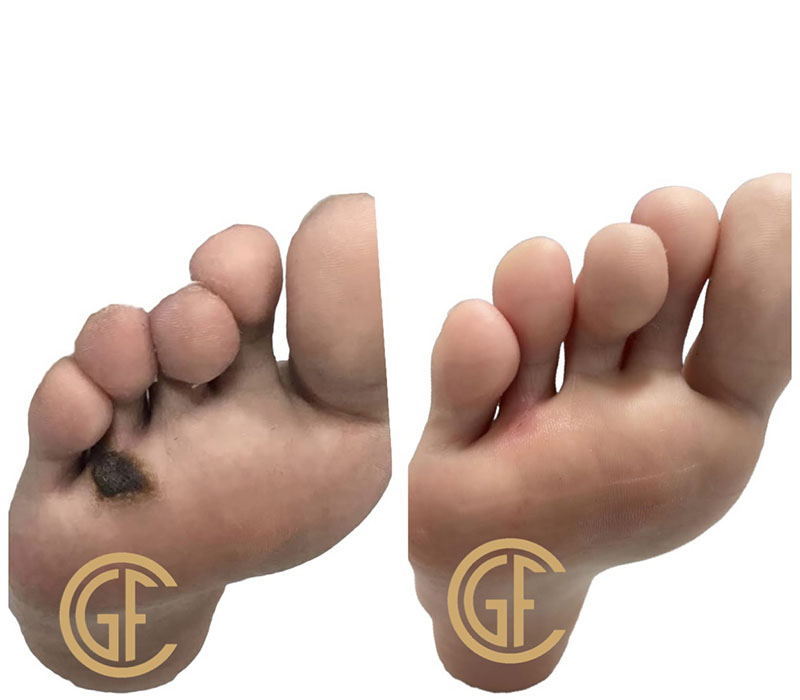 Plantar Warts Before & After Image