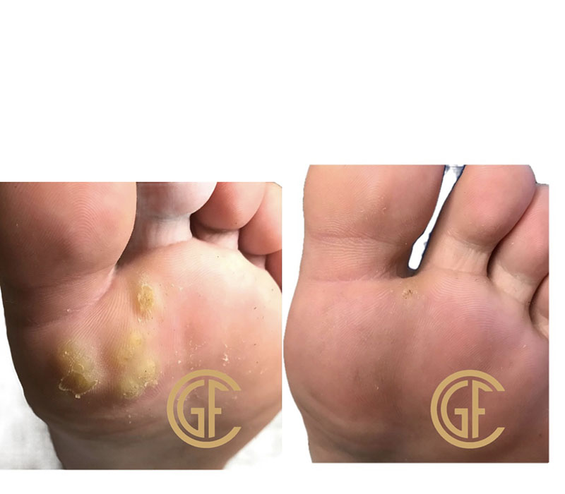 Plantar Warts Before & After Image