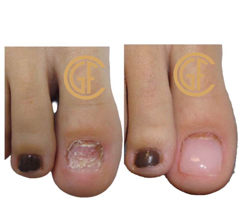 Plantar Warts Before & After Image