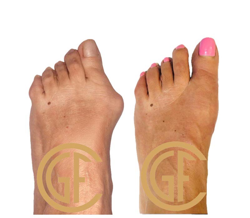Minimally Invasive Bunion Surgery Before & After Image