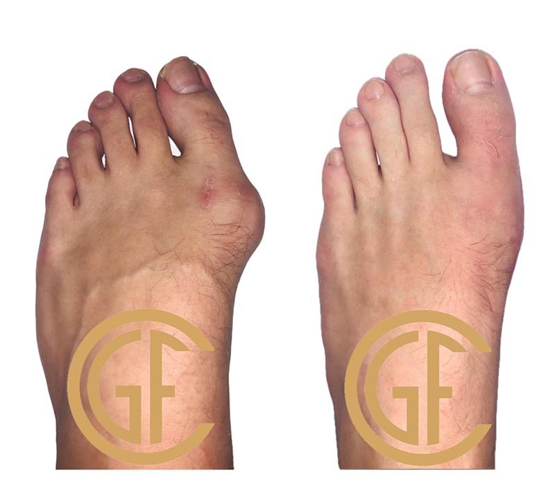 Minimally Invasive Bunion Surgery Before & After Image
