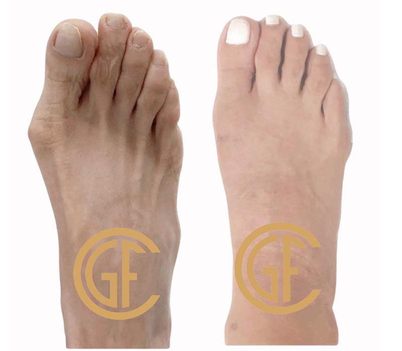 Minimally Invasive Bunion Surgery Before & After Image