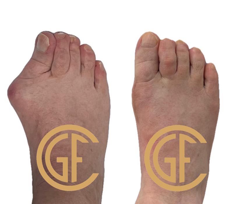 Minimally Invasive Bunion Surgery Before & After Image