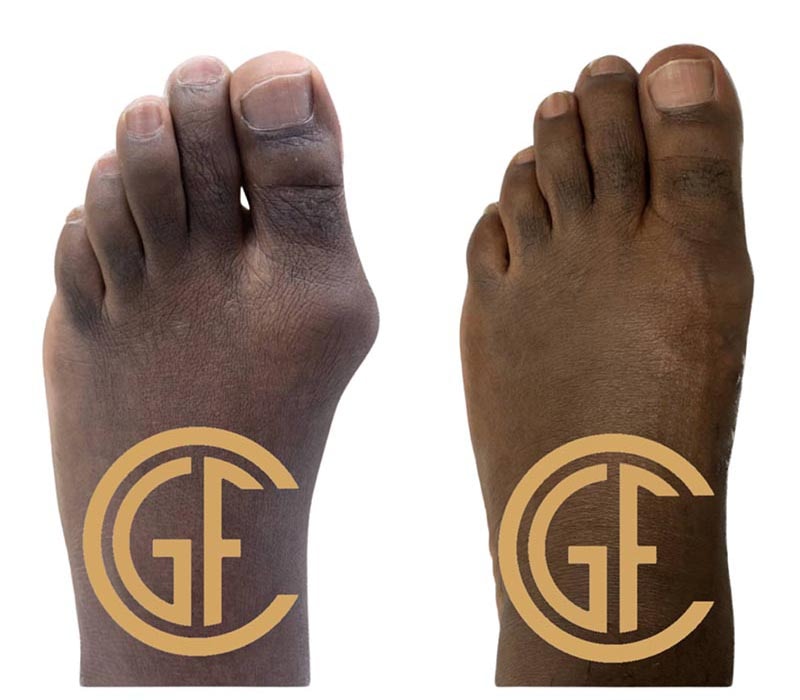 Minimally Invasive Bunion Surgery Before & After Image