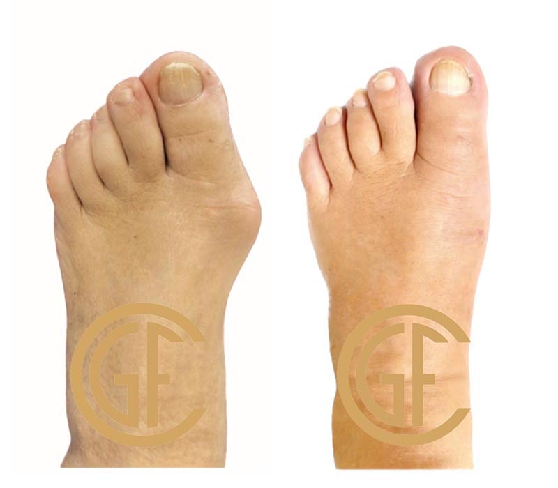 Minimally Invasive Bunion Surgery Before & After Image
