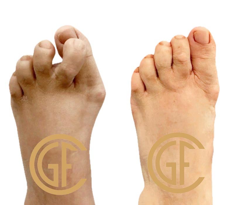 Minimally Invasive Bunion Surgery Before & After Image