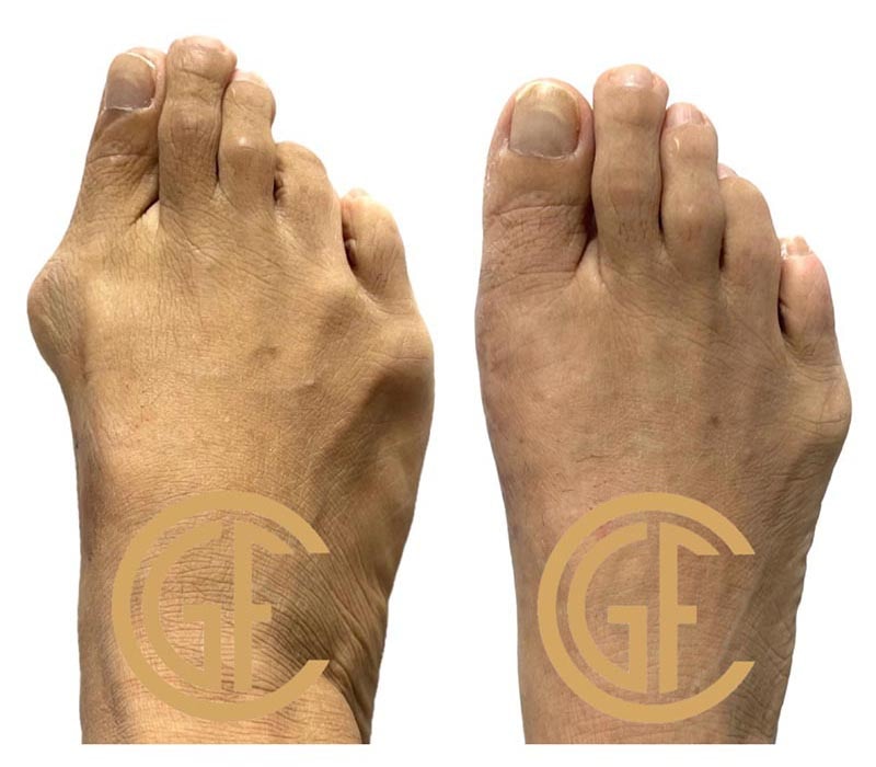 Minimally Invasive Bunion Surgery Before & After Image